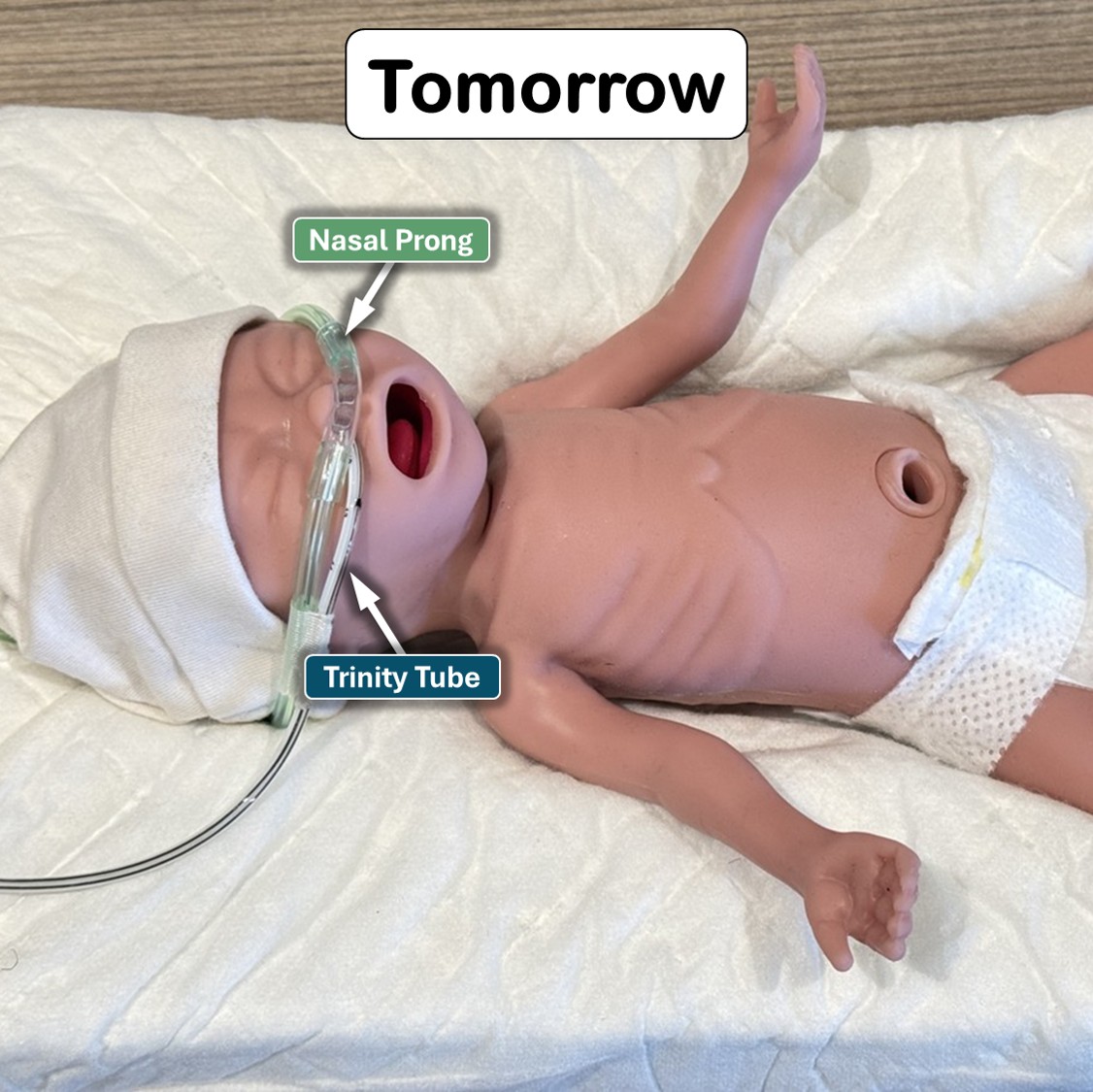 After Revised Nasogastric